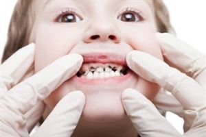 Υπάρχουν πολλοί λόγοι για τους οποίους τα παιδιά έχουν μαυρισμένα δόντια γάλακτος: