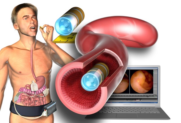 Путешествуя по пищеварительному тракту человека, устройство размером с бобовое тело фотографирует кишечник изнутри