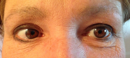 Дивергентный глаз правого глаза ( Библиотека изображений общественного здравоохранения CDC )   Рис
